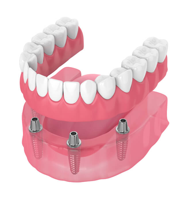 snap-in-dentures