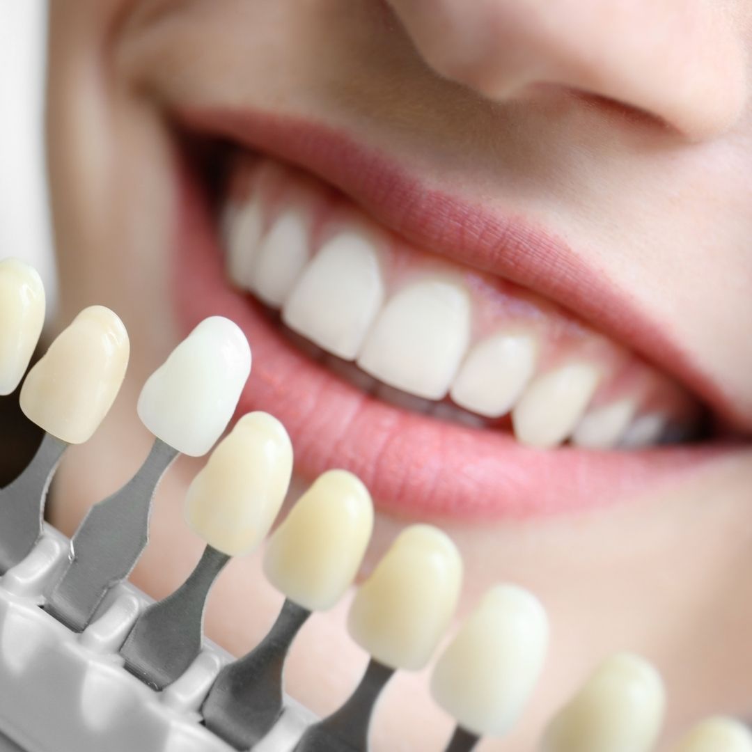 Close up of smile with white, straight teeth