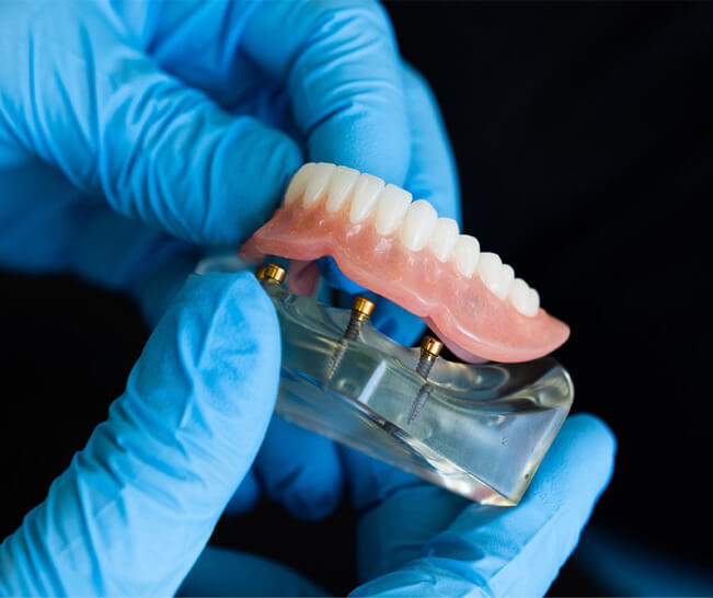 Snap-In Dentures